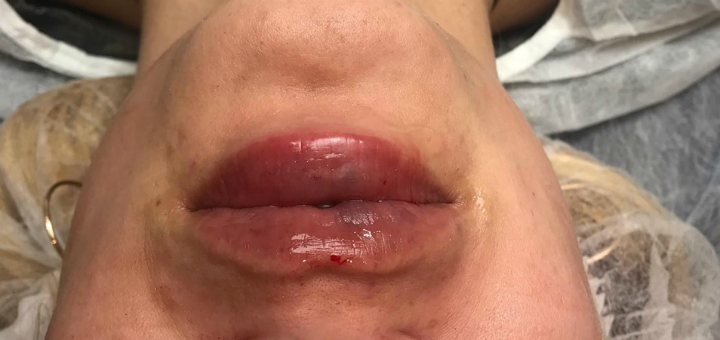 Lip augmentation
