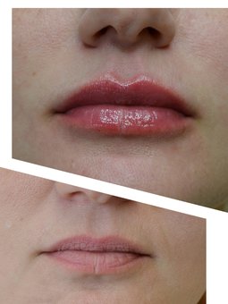 Lip augmentation with fillers at Anna Kolesnik's cosmetology studio in Kharkov. Sign up for the promotion.